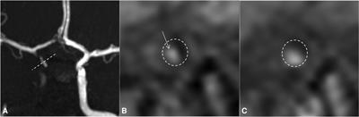 Intra-arterial vasodilators infusion for management of reversible cerebral vasoconstriction syndrome in a 12-year-old girl: A case report